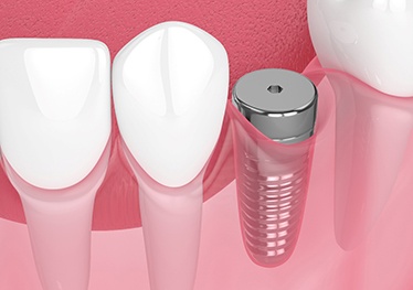 Digital illustration of dental implant in Garland