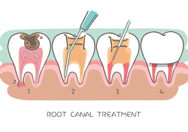 Diagram of a root canal
