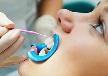 Child receiving fluoride treatment