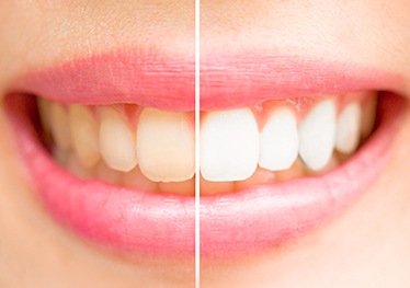 Closeup of teeth half before and half after teeth whitening