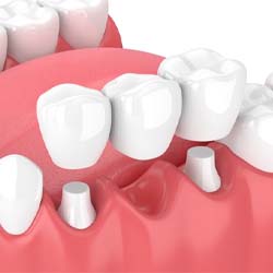 traditional dental bridge replacing a single missing tooth