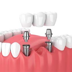 dental implant bridge replacing three missing teeth