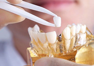 dentist putting a crown on a dental implant