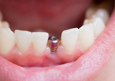 close-up of a dental implant abutment in someone’s mouth