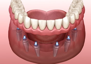 Digital illustration of implant dentures
