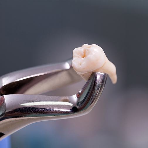 Clasp holding extracted tooth