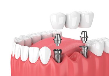 Model of dental implants in Garland, TX for a bridge