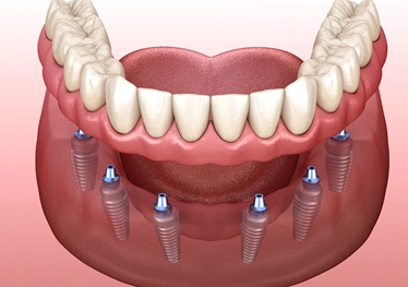 Dentures being placed on six dental implants in Garland, TX
