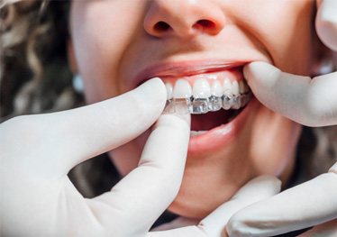 Dentist placing clear aligner on patient's top teeth