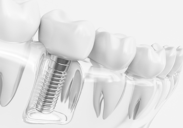 Animated dental implant