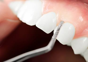 Close up of healthy gums being measured by dentist