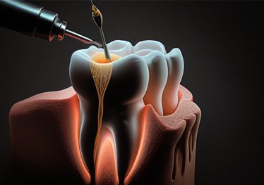 Digital illustration of a root canal