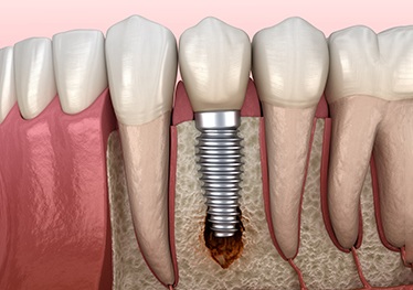 Illustration of infection around dental implant