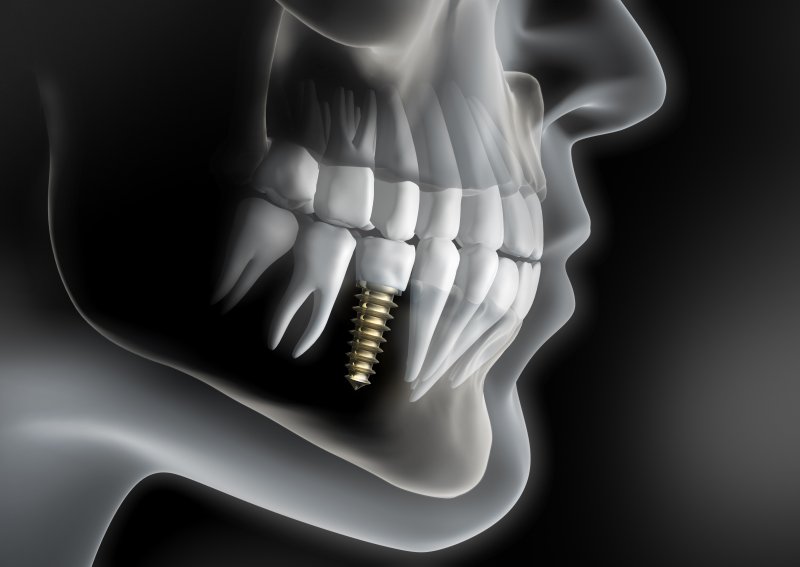 a digital image of a skeleton with a single tooth dental implant in the lower arch