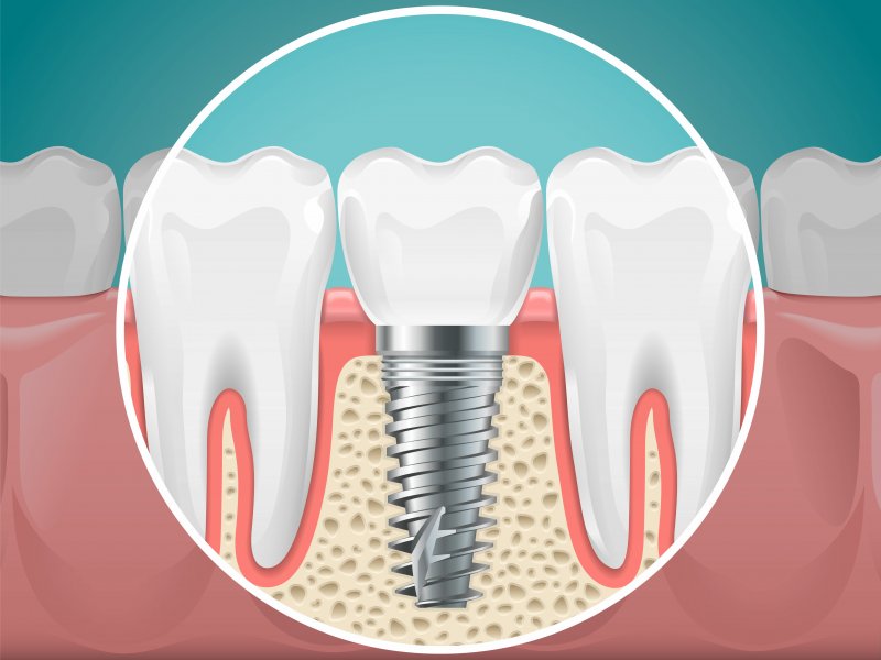 3-D model of a dental implant