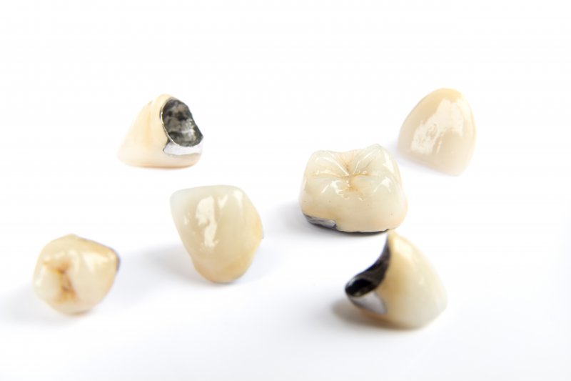 multiple porcelain fused to metal dental crowns